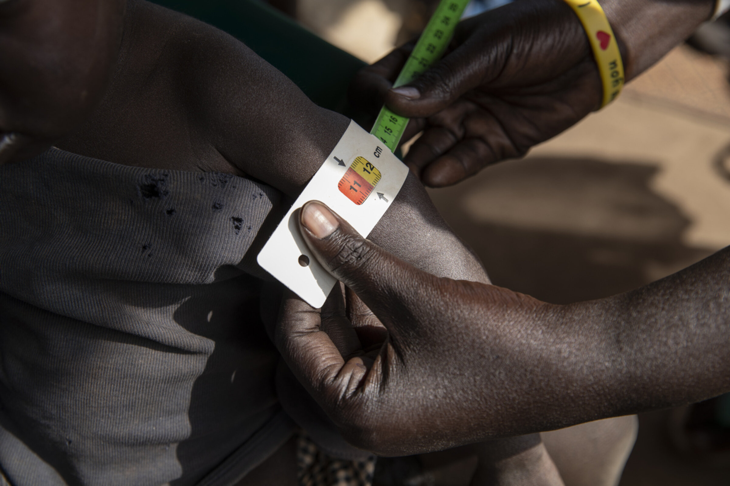 Unterernährung im Südsudan