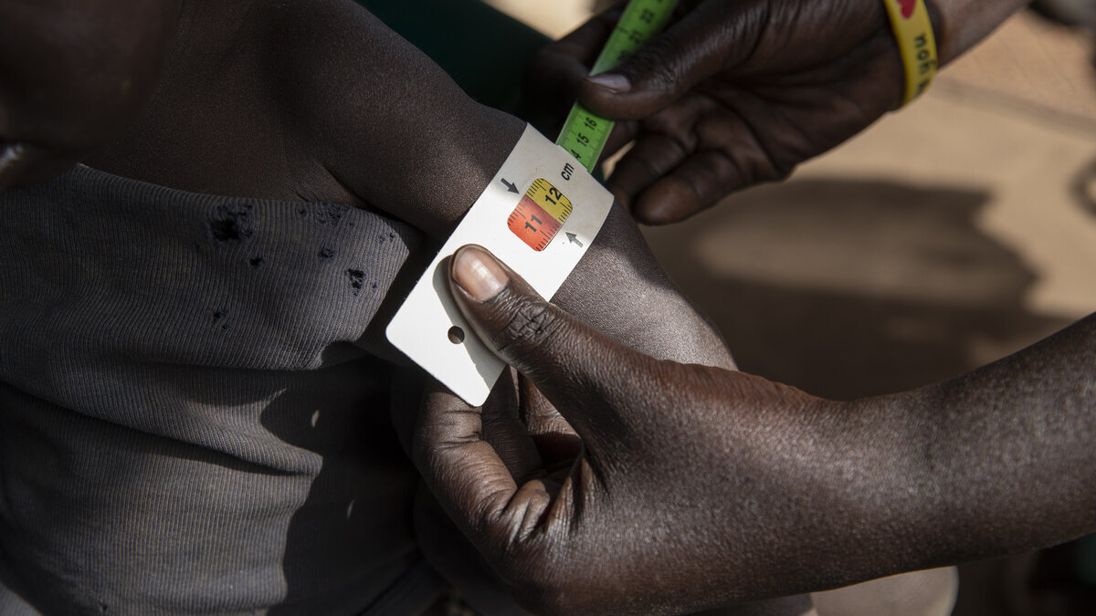 Spenden Hunger: Unterernähurng im Südsudan Messung der Unterernährung bei einem Kleinkind mit dem MUAC-Band